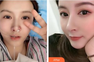 萊州市慢性病防治院醫(yī)療美容中心劉林剛整形價格表附激光美膚激光案例展示