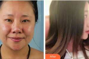 渭南市臨渭區(qū)衛(wèi)生學(xué)校附屬醫(yī)院整形激光美容科胡遠(yuǎn)征整形價格表附埋線提升案例展示