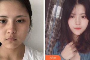 上虞亞韓醫(yī)療美容美容醫(yī)院吳明埈整形價格表附鼻部綜合案例展示
