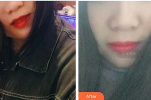 廣水市第一人民醫(yī)院整形外科吳禮輝整形價格表附牙齒隱形矯正案例展示