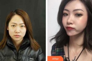 寧海第一醫(yī)院醫(yī)療美容科張海靜整形價格表附埋線提升案例展示