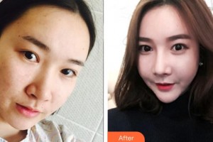 林潔靈住院醫(yī)師整形價格表附埋線提升案例展示