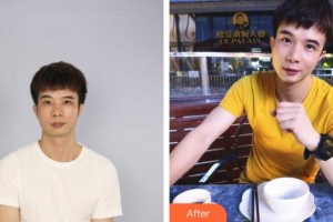 李賢擇整形價格表附埋線提升案例展示