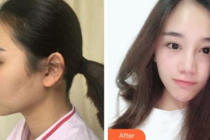 侯馬晨暉醫(yī)學(xué)美容門診部李晉才整形價格表附埋線提升案例展示