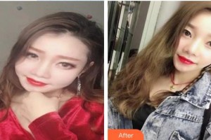 蘭溪市人民醫(yī)院整形燒傷外科廖和根整形價格表附超聲提拉案例展示