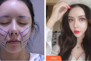 上虞市人民醫(yī)院整形科丁帆整形價格表附埋線提升案例展示