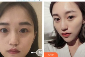 睢寧圣蓉醫(yī)療美容診所魏子整形價格表附埋線提升案例展示