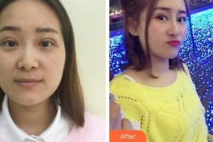 丹陽市人民醫(yī)院整形外科王延明整形價格表附激光美膚激光案例展示