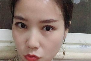 三亞人民醫(yī)院割雙眼皮果好不好附案例|2021價(jià)格表