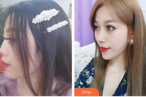 沭陽縣人民醫(yī)院皮膚整形美容科王慶明整形價格表附鼻部綜合案例展示