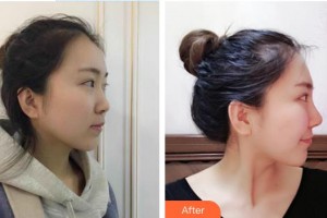 沭陽縣人民醫(yī)院皮膚整形美容科張磊整形價格表附假體隆鼻案例展示