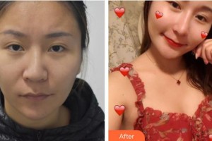 溧陽圣藍(lán)醫(yī)院整形美容中心相汝東整形價格表附鼻修復(fù)案例展示