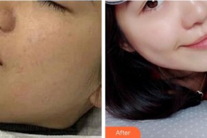 惠州劉偉勇醫(yī)療美容診所劉偉勇整形價格表附激光美膚激光案例展示