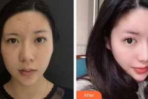 陽江安琪兒婦產(chǎn)醫(yī)院整形美容中心何艷屏整形價格表附熱瑪吉案例展示