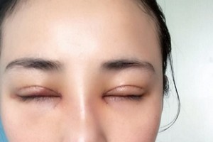 沈陽一大二院整形外科好不好隆鼻2021價(jià)格|案例