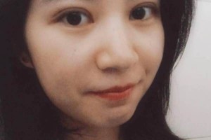 ?復(fù)旦大學(xué)附屬中山醫(yī)院怎么樣？附埋線雙眼皮果圖