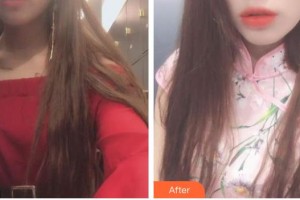 安岳潤(rùn)白顏醫(yī)療整形美容門診部蔣永強(qiáng) 整形價(jià)格表附紅藍(lán)光祛痘案例展示