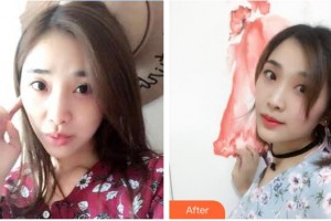 平?jīng)隹得泪t(yī)療美容門診部于曉萍整形價(jià)格表附光子嫩膚案例展示