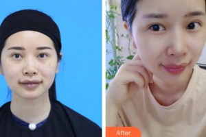 安岳潤(rùn)白顏醫(yī)療整形美容門診部于華平整形價(jià)格表附微針?biāo)獍咐故?>
</a>
<h3 class=