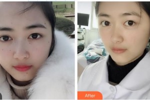 鞍鋼集團(tuán)總醫(yī)院醫(yī)療美容醫(yī)院樊薔薇整形價(jià)格表附祛斑祛痣案例展示