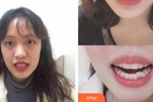 吳江邵新農(nóng)口腔診所王學(xué)娟整形價(jià)格表附口腔牙齒矯正案例展示