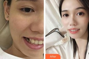 京良鄉(xiāng)優(yōu)貝口腔門診部姜茂慶整形價(jià)格表附金屬托槽矯正案例展示