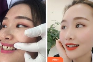 溧陽(yáng)幫明口腔門診部汪保任整形價(jià)格表附牙齒隱形矯正案例展示