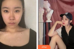 臨清市人民醫(yī)院手足顯微燒傷整形外科劉秉銳整形價(jià)格表附埋線提升案例展示