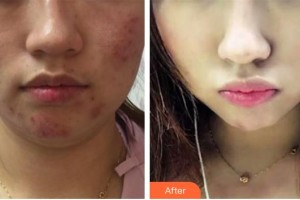 臨清市人民醫(yī)院手足顯微燒傷整形外科商昌軍整形價(jià)格表附埋線提升案例展示