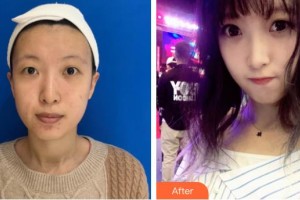 吉首市人民醫(yī)院整形美容科余強(qiáng)整形價(jià)格表附埋線提升案例展示