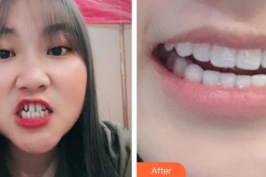 高郵海潮口腔門診部吳耀明整形價格表附牙貼面案例展示