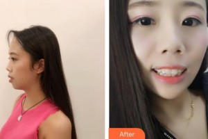 楚雄龐氏口腔門診部王蔚整形價格表附牙齒隱形矯正案例展示