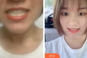 楚雄龐氏口腔門診部高恩峰整形價格表附牙齒隱形矯正案例展示