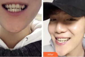 西藏阜康醫(yī)院口腔科莊慶整形價格表附牙齒隱形矯正案例展示