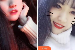 西藏阜康醫(yī)院口腔科丁劍整形價格表附金屬托槽矯正案例展示