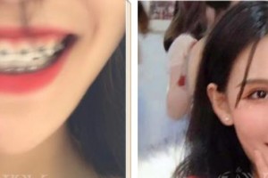 西藏阜康醫(yī)院口腔科劉瑞楠整形價格表附美白貼片案例展示