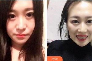 西藏阜康醫(yī)院口腔科范贇韜整形價格表附金屬托槽矯正案例展示