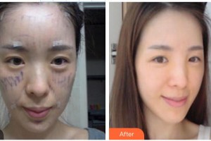 翁瑞主診醫(yī)師整形價格表附熱拉提案例展示