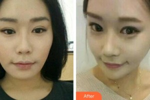 李寧生整形價格表附埋線提升案例展示