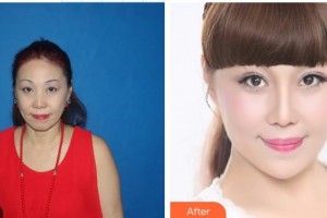 汪志強(qiáng)整形價格表附埋線提升案例展示