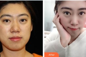 公安縣中西結(jié)合燒傷醫(yī)院燒傷整形美容科徐昌瑛整形價格表附熱瑪吉案例展示