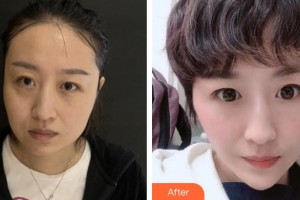 臨清市人民醫(yī)院手足顯微燒傷整形外科田培文整形價格表附熱瑪吉案例展示