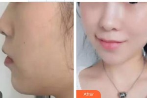 渭南凡爾賽明雅醫(yī)療美容診所曾祥文整形價格表附埋線提升案例展示