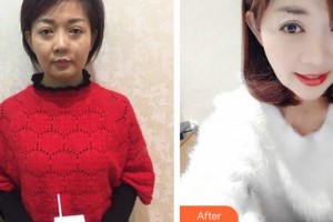 沾化縣人民醫(yī)院整形美容科王玉整形價格表附埋線提升案例展示