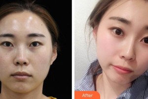 成武縣人民醫(yī)院醫(yī)學(xué)美容科邵兆銀住院醫(yī)師整形價格表附熱瑪吉案例展示