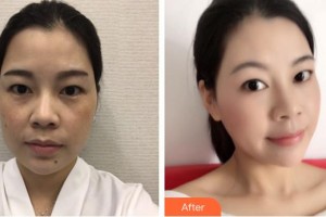 成武縣人民醫(yī)院醫(yī)學(xué)美容科張鳳云整形價格表附埋線提升案例展示