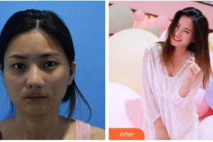 張掖市人民醫(yī)院美容整形科張著杰整形價格表附埋線提升案例展示