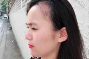 廣西醫(yī)科大一附院有稙發(fā)嗎？附發(fā)際線種植果圖