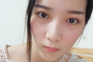 徐州市二院整形科怎么樣？附埋線雙眼皮果圖