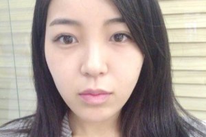 上海同濟(jì)整形醫(yī)院雙眼皮手術(shù)果案例對比圖